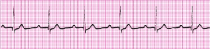 Identify the following rhythm: _________________________