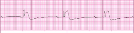 Identify the following rhythm: _________________________
