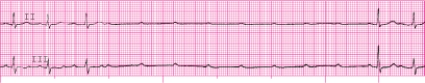 Identify the following rhythm: _________________________