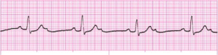 Identify the following rhythm: _________________________