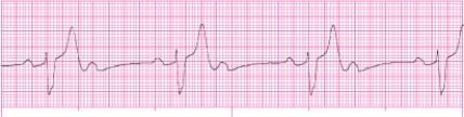 Identify the following rhythm: _________________________