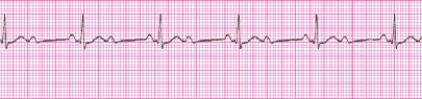 Identify the following rhythm: _________________________