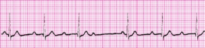 Identify the following rhythm: _________________________