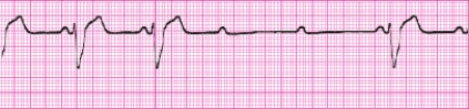 Identify the following rhythm: _________________________
