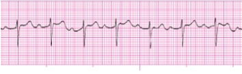 Identify the following rhythm: _________________________