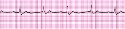Identify the following rhythm: _________________________