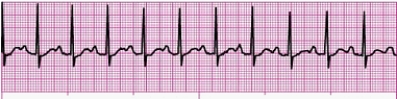 Identify the following rhythm: _________________________