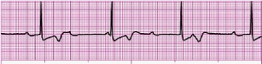 Identify the following rhythm: _________________________