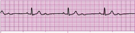 Identify the following rhythm: _________________________