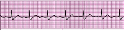 Identify the following rhythm: _________________________