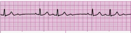 Identify the following rhythm: _________________________