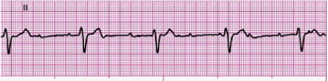 Identify the following rhythm: _________________________