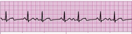 Identify the following rhythm: _________________________