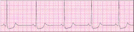 Identify the following rhythm (lead II): ____________________