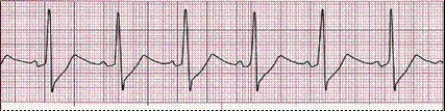Identify the following rhythm (lead II): ____________________