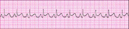 Identify the following rhythm (lead II): ____________________