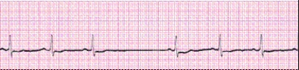 Identify the following rhythm (lead II): ____________________