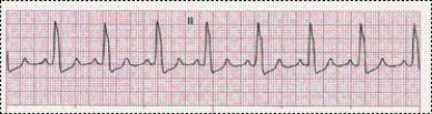 Identify the following rhythm: ____________________