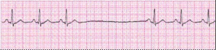 Identify the following rhythm (lead II): ____________________