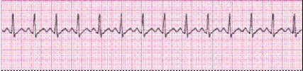 Identify the following rhythm (lead II): ____________________