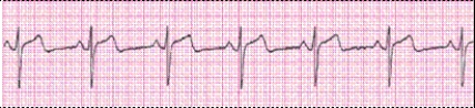 Identify the following rhythm (lead II): ____________________