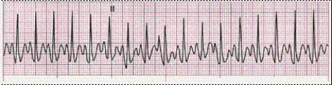 Identify the following rhythm (lead II): ____________________