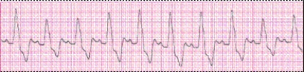 Identify the following rhythm (lead II): ____________________
