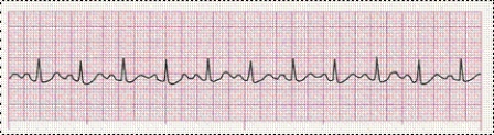 Identify the following rhythm (lead II): ____________________