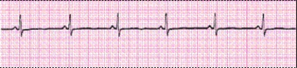 Identify the following rhythm (lead II): ____________________