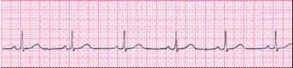 Identify the following rhythm (lead II): ____________________