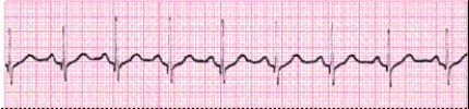 Identify the following rhythm (lead II): ____________________