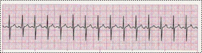 Identify the following rhythm (lead I): ____________________