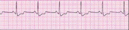 Identify the following rhythm (lead II): ____________________