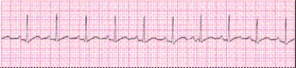 Identify the following rhythm (lead II): ____________________