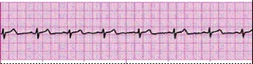 Identify the following rhythm (lead II): ____________________