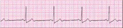 Identify the following rhythm (lead II): ____________________