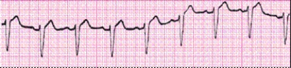 Identify the following rhythm (lead II): ____________________