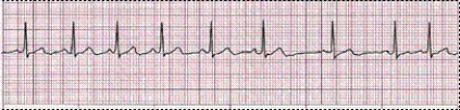 Identify the following rhythm (lead II): ____________________