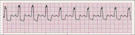Identify the following rhythm (lead II): ____________________