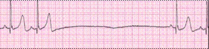 Identify the following rhythm (lead II): ____________________