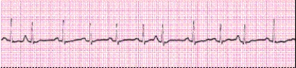<strong>Identify the following rhythm (lead II). </strong> A) Atrial fibrillation B) Sinus arrhythmia C) Multifocal atrial tachycardia D) Sinus tachycardia with premature atrial complexes (PACs)