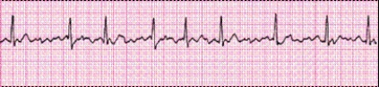 <strong>P waves in this rhythm strip _____. </strong> A) are upright before every QRS complex B) are inverted before every QRS complex C) vary in size and shape D) are not identifiable