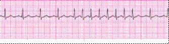 <strong>Identify the following rhythm (lead II). </strong> A) Sinus arrhythmia B) Atrial tachycardia C) Multifocal atrial tachycardia with a PAC D) Sinus rhythm with a PAC, a run of PSVT, back to a sinus rhythm