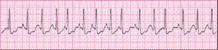 <strong>P waves in this rhythm strip _____. </strong> A) are upright before every QRS complex B) are inverted before every QRS complex C) vary in size and shape D) are not identifiable