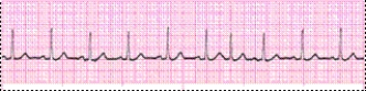 <strong>Identify the following rhythm (lead II). </strong> A) Sinus arrhythmia B) Sinus tachycardia C) Sinus rhythm with a PAC D) Sinus tachycardia with a PAC
