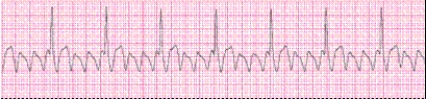 <strong>Identify the following rhythm (lead II). </strong> A) Atrial flutter B) Atrial fibrillation C) Wolff-Parkinson-White syndrome D) AV nodal reentrant tachycardia (AVNRT)