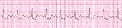 <strong>P waves in this rhythm strip _____. </strong> A) occur regularly B) are not identifiable; fibrillatory waves are present C) are upright before every QRS complex D) are not identifiable; flutter waves are present