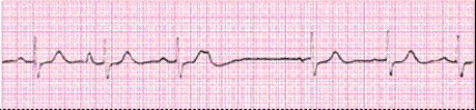Identify the following rhythm (lead II): ____________________
