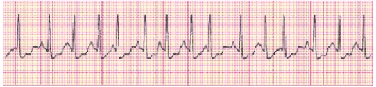 Identify the following rhythm (lead II): ____________________