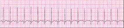 Identify the following rhythm (lead II): ____________________